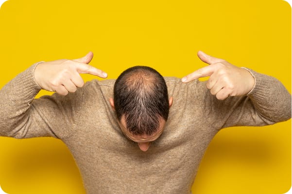 Hair Loss: What Causes It—and What Can You Do?