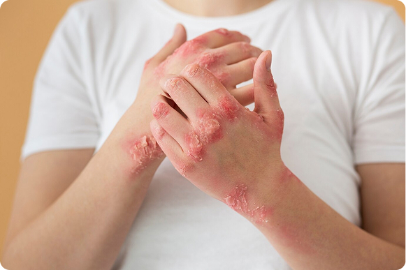 Common Conditions Treated with Steroids